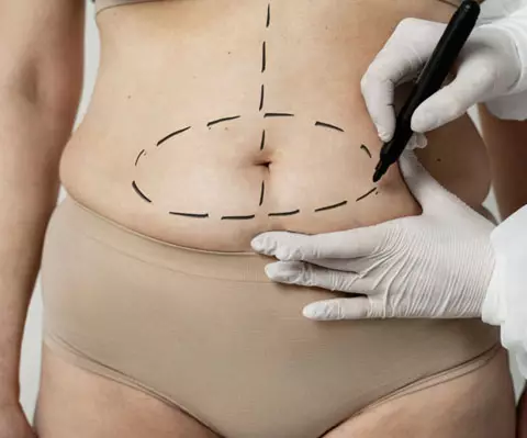 cirurgiao-plastico-rio-de-janeiro-procedimentos-cirurgicos-Abdominoplastia